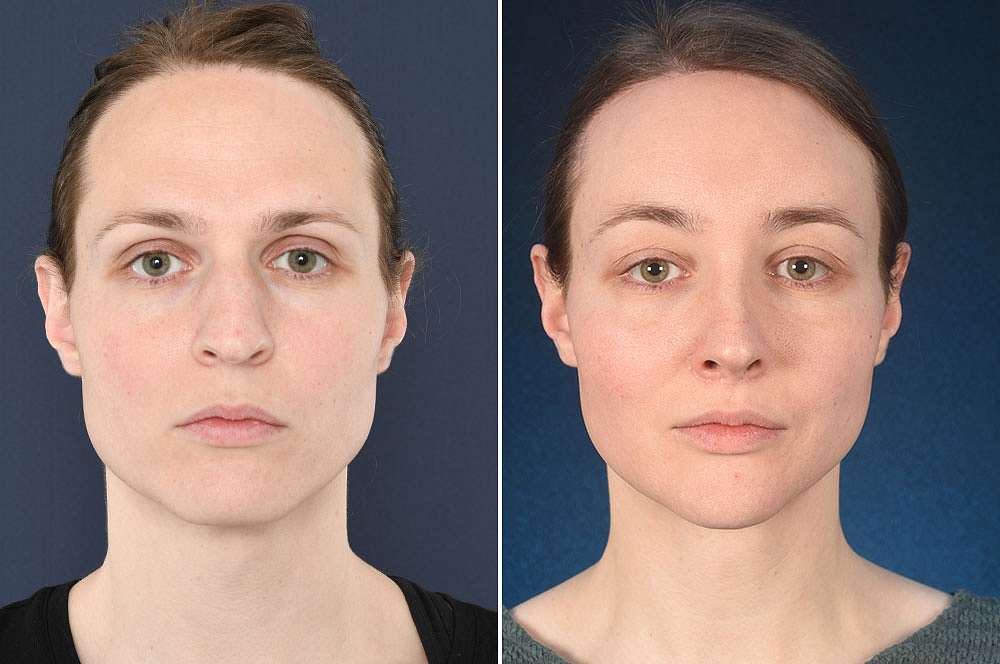 Simone before and after Facial Feminization Surgery 