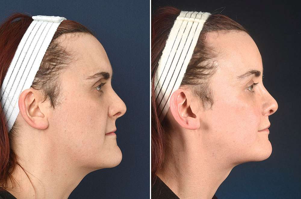 Jennifer voor en na Facial Feminization Surgery