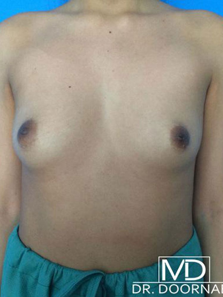 Breast implants - Mtf before BFS