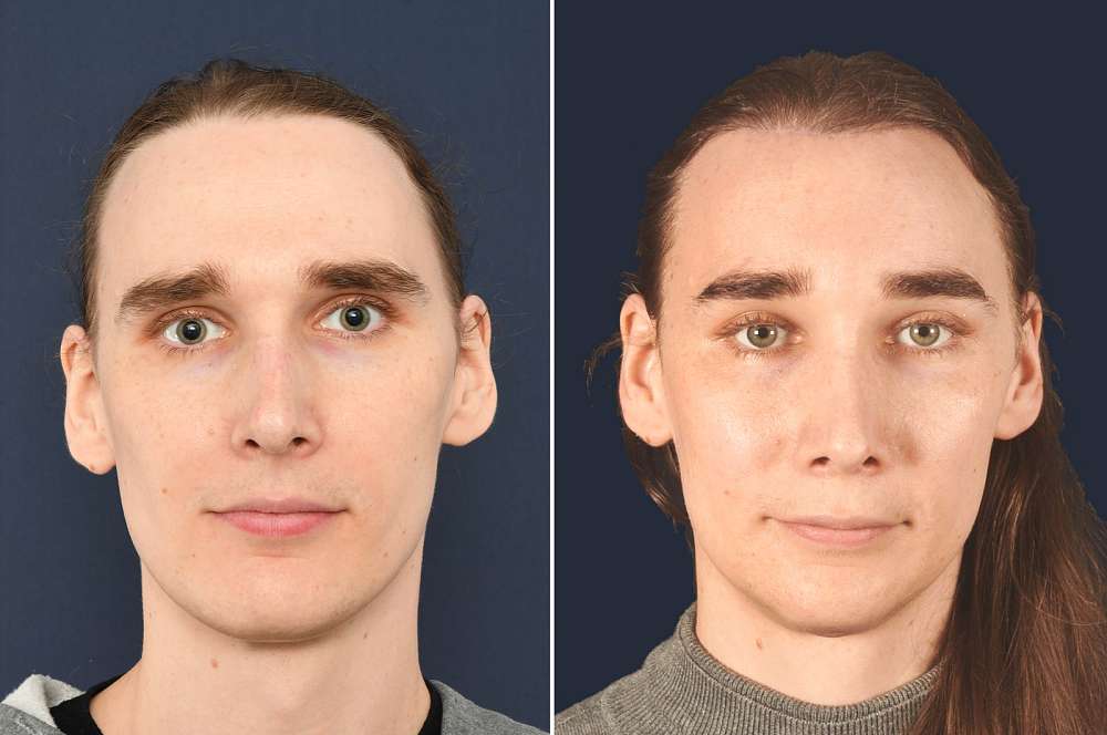 Julia vor und nach der Feminisierung des Gesichts
