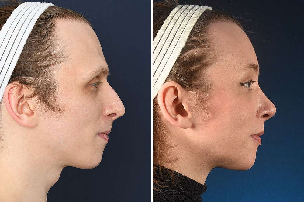 Demelza voor en na Facial Feminization Surgery