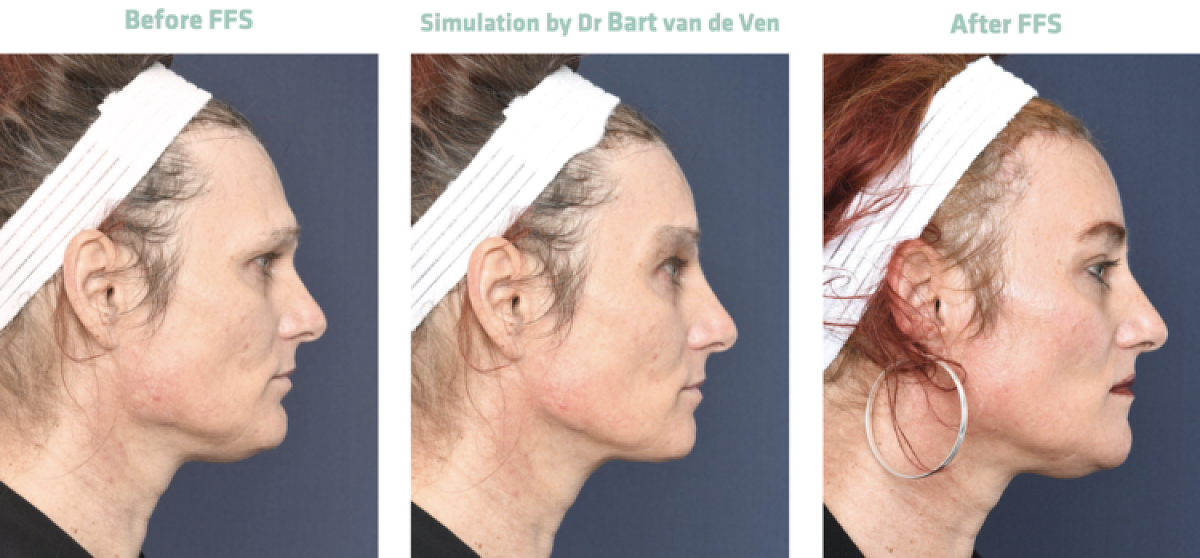 Picture simulation Facial Feminization Surgery Jessica