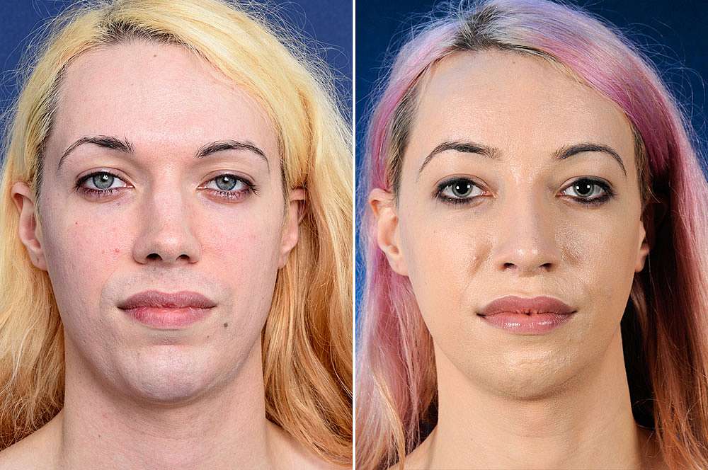 Evelyn voor en na Facial Feminization Surgery