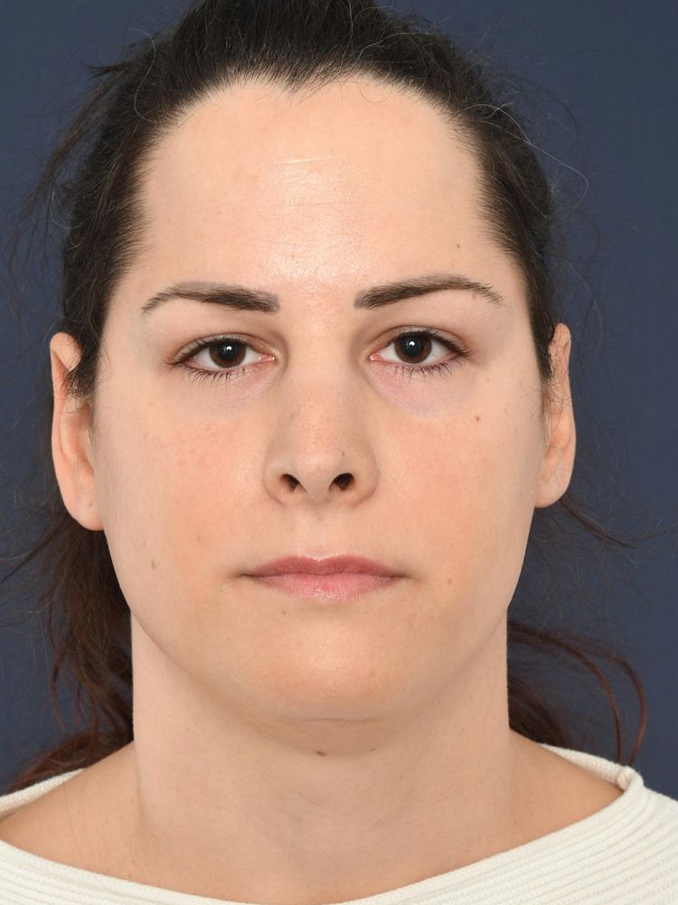 Before Facial Feminization Surgery Annalena