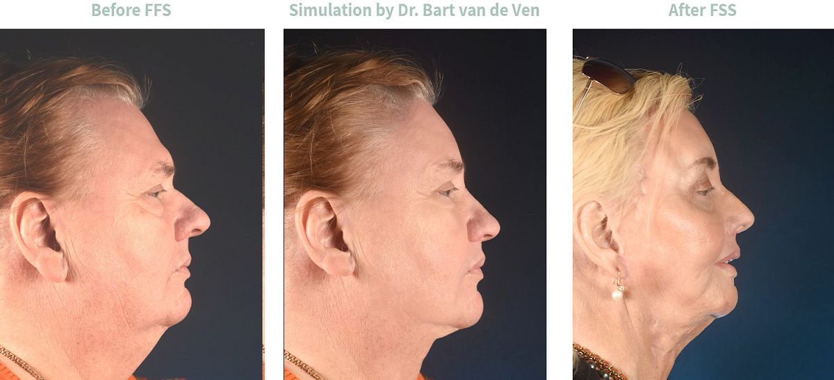 Picture simulation Facial Feminization Surgery Louise