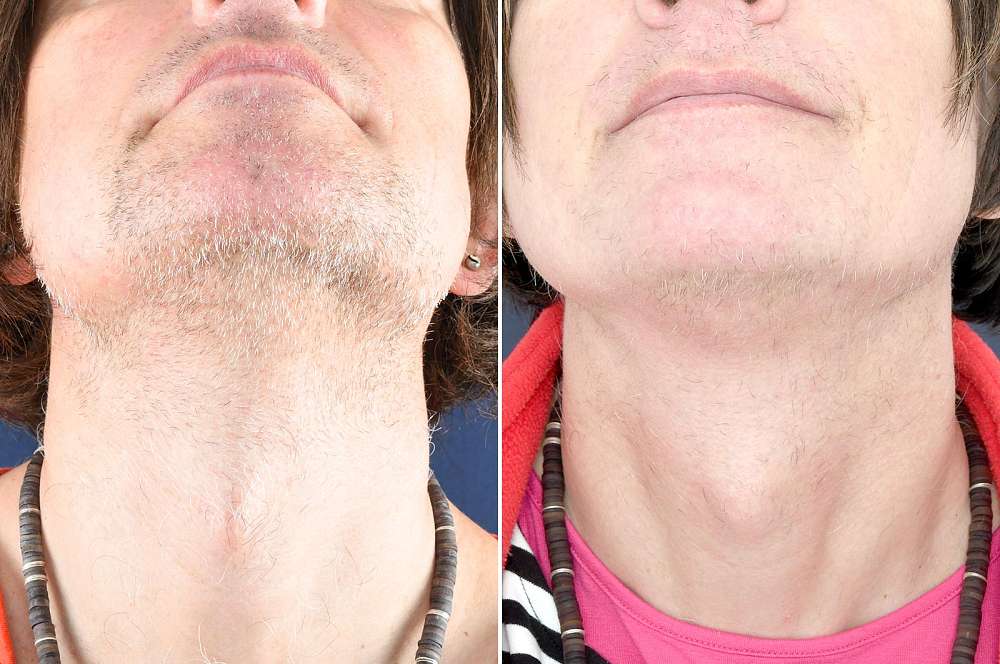 Result after 60 hours electrolysis before and after 