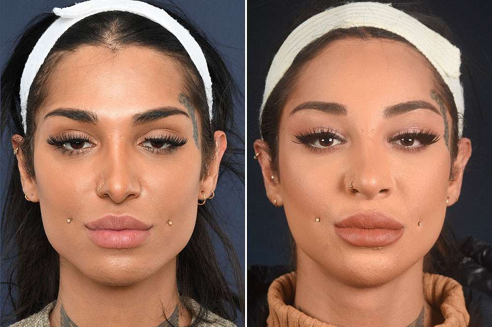 Alev before and after Facial Feminization Surgery 