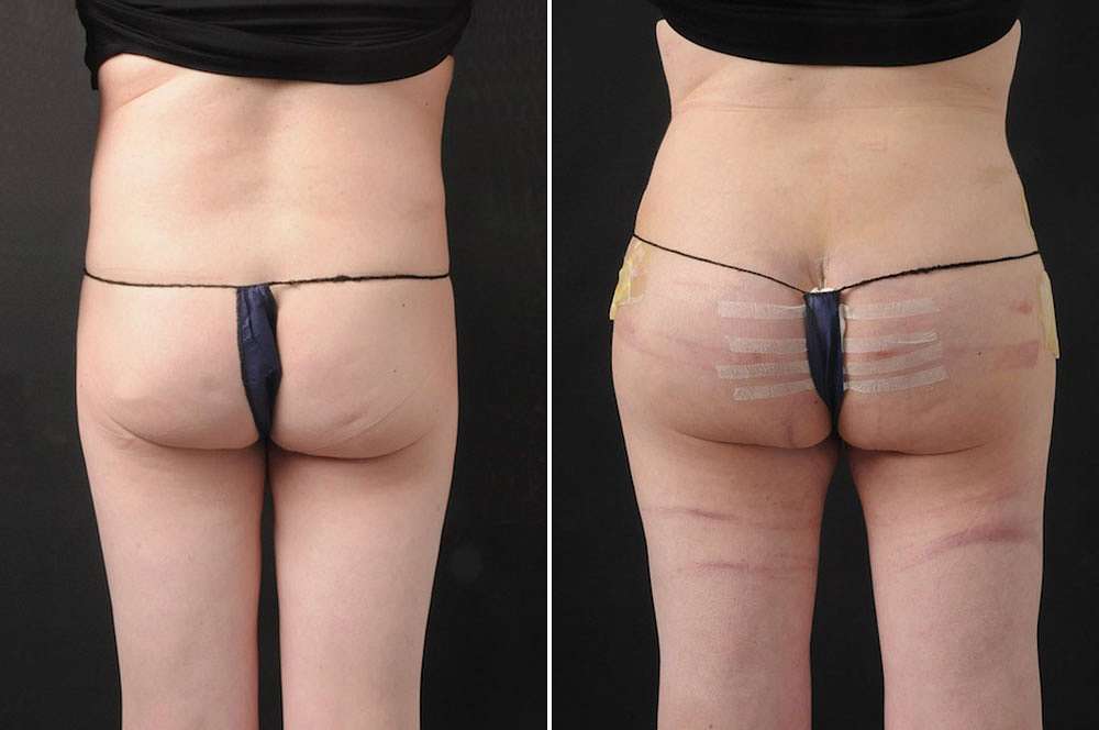 Hip implants voor en na Body Feminization Surgery