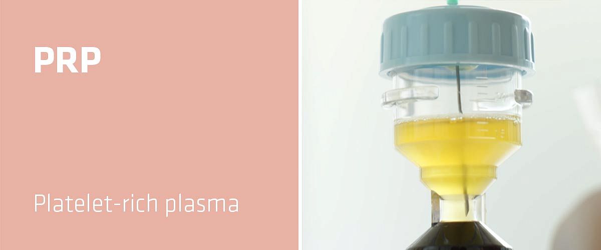 Plättchenreiches Plasma t (PRP) und Haartransplantationen: die magische Kombination