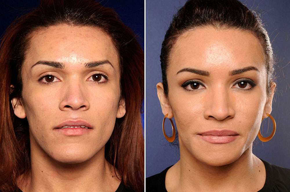 Maria voor en na Facial Feminization Surgery