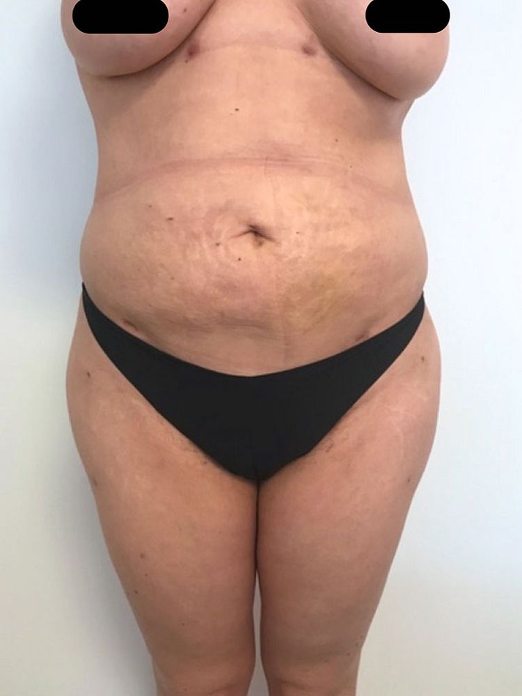 Hip augmentation by fat transfer na BFS