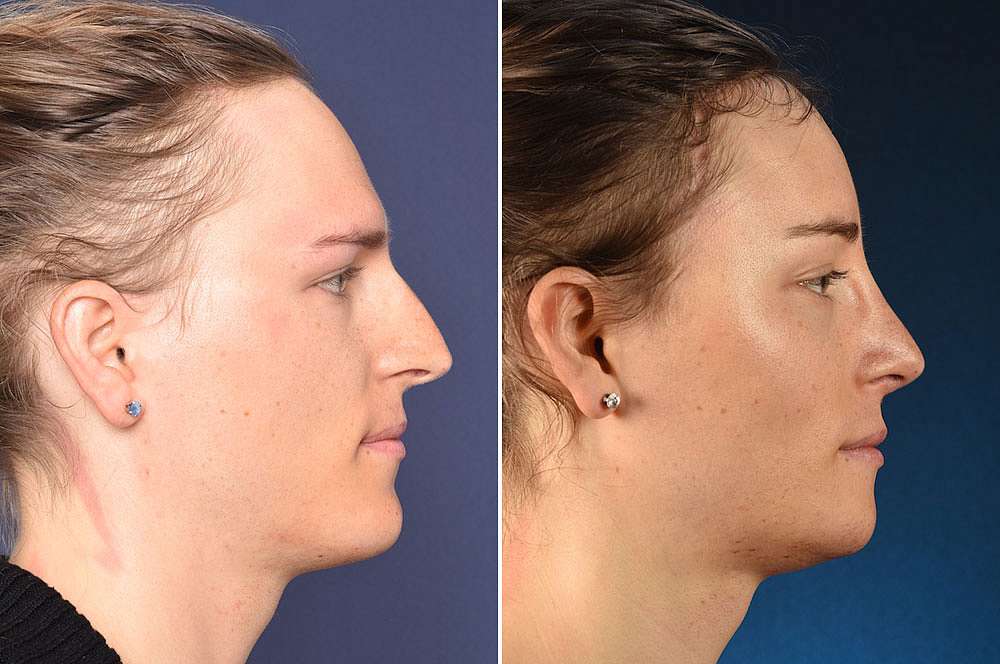 Vanessa voor en na Facial Feminization Surgery