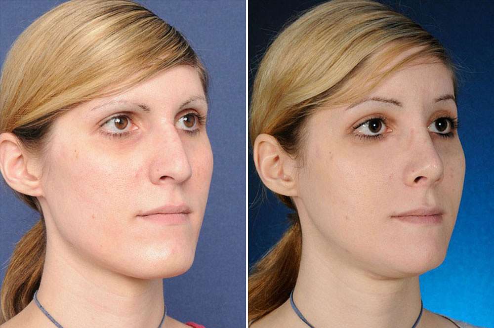 Francesca voor en na Facial Feminization Surgery
