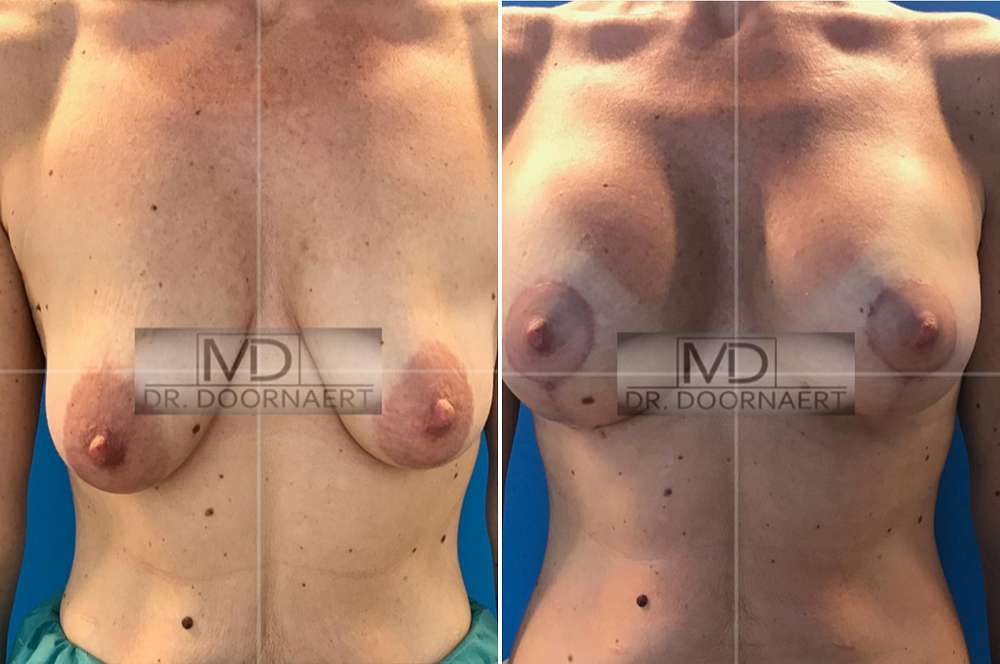 With implant before and after Body Feminization Surgery