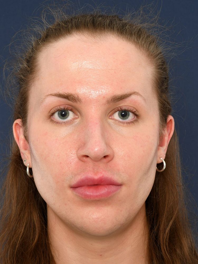 Before Facial Feminization Surgery Eden