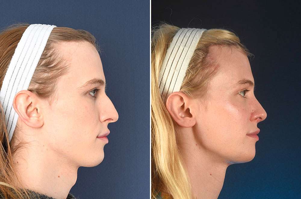 Lyra voor en na Facial Feminization Surgery