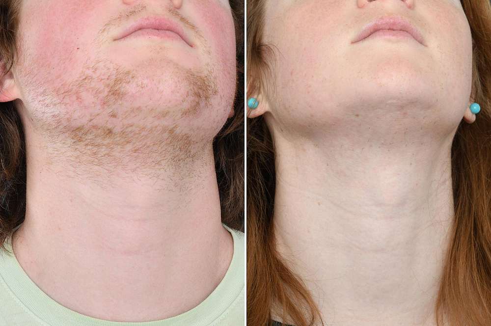 Result after 61 hours electrolysis before and after 