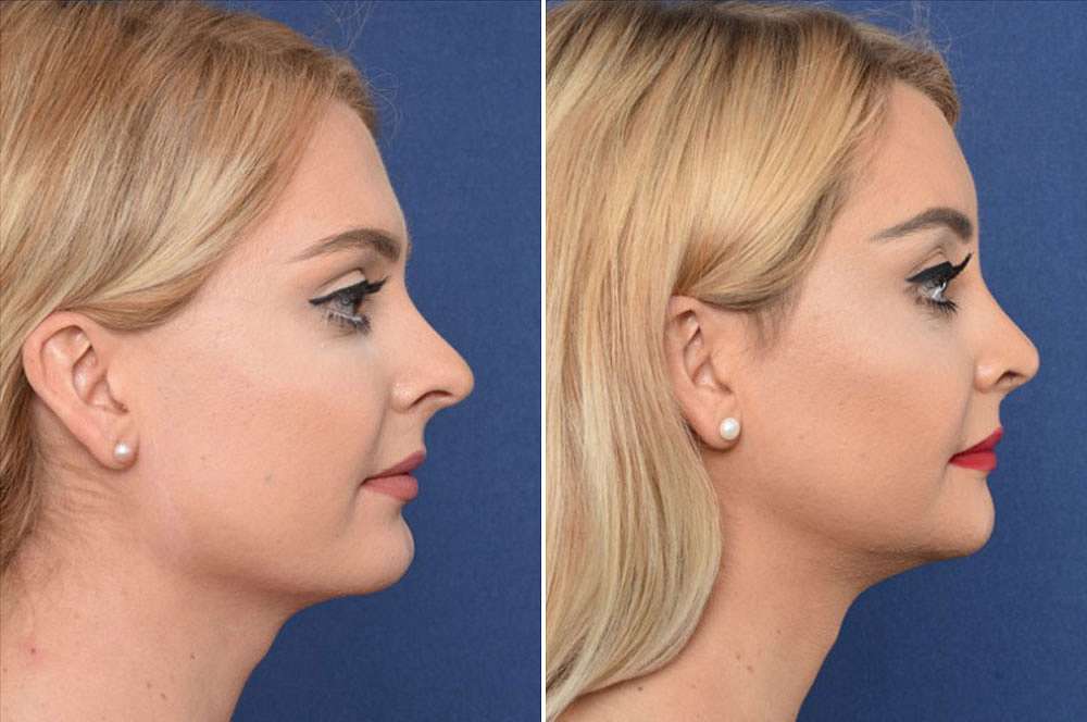 Nicole voor en na Facial Feminization Surgery