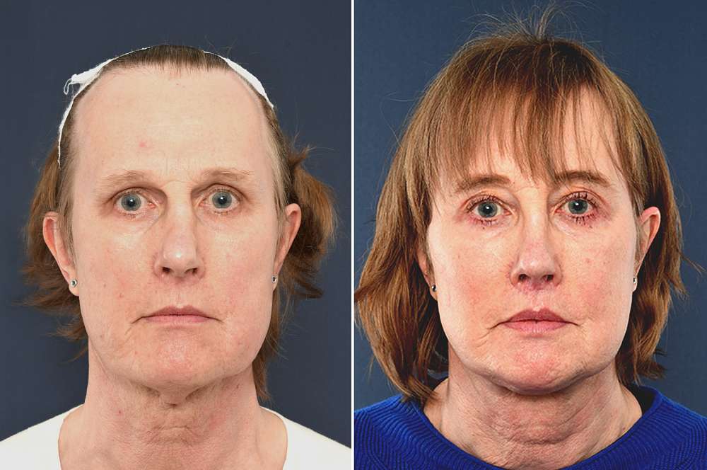 Rachael voor en na Facial Feminization Surgery