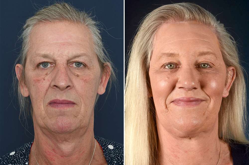 Paige voor en na Facial Feminization Surgery